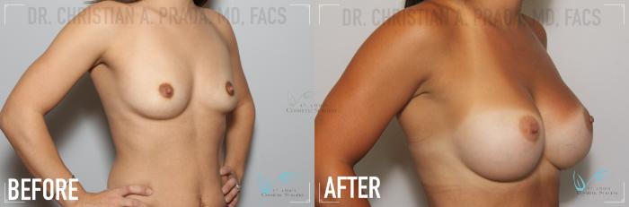 Before & After Breast Augmentation Case 137 Right Oblique View in St. Louis, MO