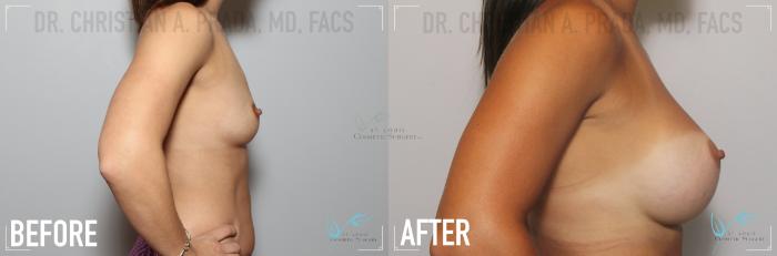 Before & After Breast Augmentation Case 137 Right Side View in St. Louis, MO