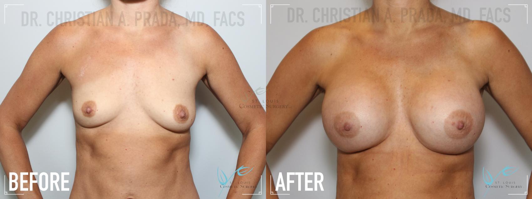 Before & After Breast Augmentation Case 138 Front View in St. Louis, MO