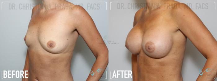 Before & After Breast Augmentation Case 138 Left Oblique View in St. Louis, MO