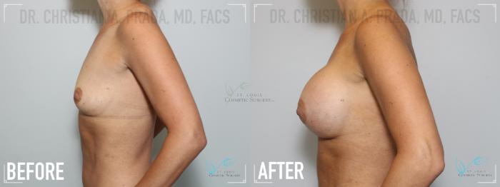 Before & After Breast Augmentation Case 138 Left Side View in St. Louis, MO