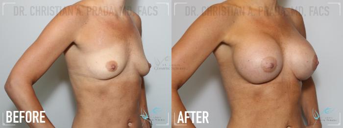 Before & After Breast Augmentation Case 138 Right Oblique View in St. Louis, MO