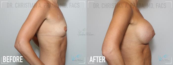 Before & After Breast Augmentation Case 138 Right Side View in St. Louis, MO