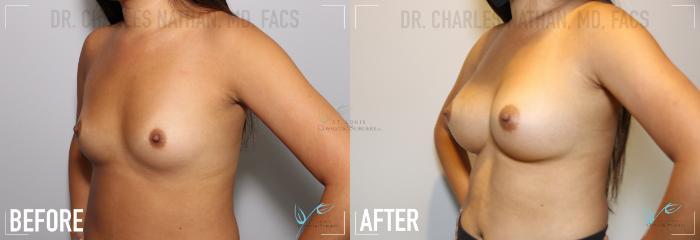 Before & After Breast Augmentation Case 141 Left Oblique View in St. Louis, MO