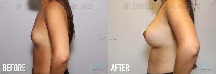 Before & After Breast Augmentation Case 141 Left Side View in St. Louis, MO