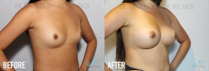 Before & After Breast Augmentation Case 141 Right Oblique View in St. Louis, MO
