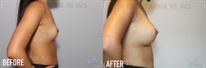 Before & After Breast Augmentation Case 141 Right Side View in St. Louis, MO