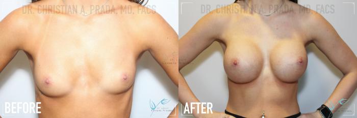 Before & After Breast Augmentation Case 142 Front View in St. Louis, MO
