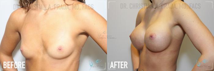 Before & After Breast Augmentation Case 142 Left Oblique View in St. Louis, MO