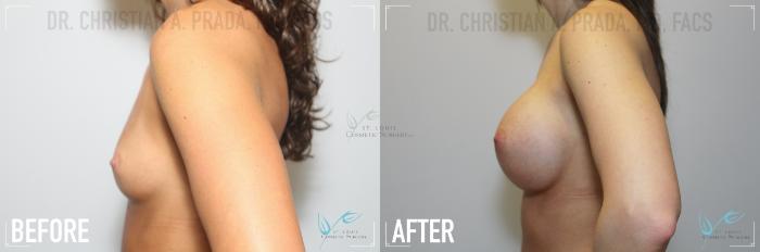 Before & After Breast Augmentation Case 142 Left Side View in St. Louis, MO
