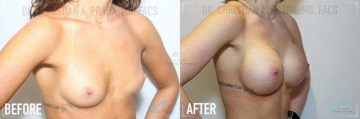 Before & After Breast Augmentation Case 142 Right Oblique View in St. Louis, MO
