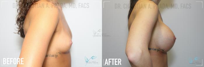Before & After Breast Augmentation Case 142 Right Side View in St. Louis, MO