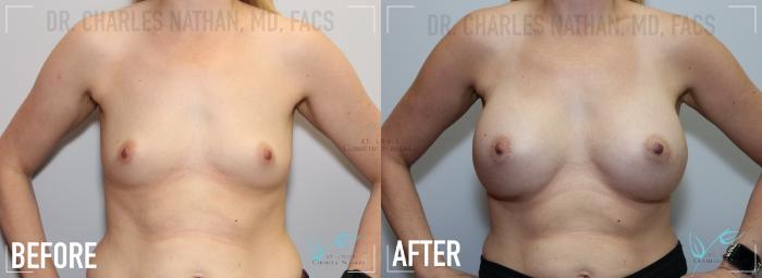 Before & After Breast Augmentation Case 143 Front View in St. Louis, MO