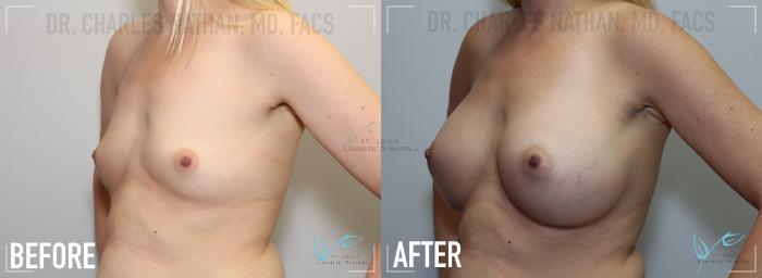 Before & After Breast Augmentation Case 143 Left Oblique View in St. Louis, MO