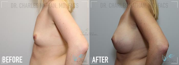 Before & After Breast Augmentation Case 143 Left Side View in St. Louis, MO