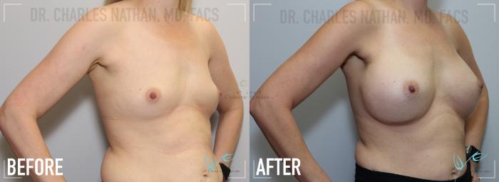 Before & After Breast Augmentation Case 143 Right Oblique View in St. Louis, MO