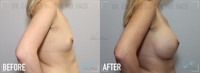 Before & After Breast Augmentation Case 143 Right Side View in St. Louis, MO