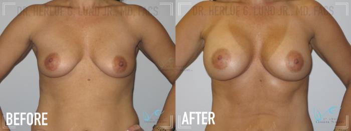 Before & After Breast Augmentation Case 149 Front View in St. Louis, MO