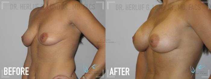 Before & After Breast Augmentation Case 149 Left Oblique View in St. Louis, MO