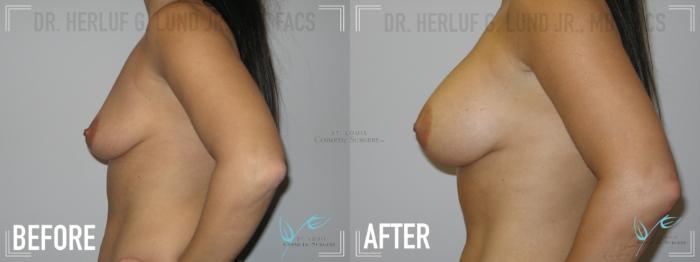 Before & After Breast Augmentation Case 149 Left Side View in St. Louis, MO