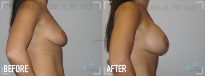 Before & After Breast Augmentation Case 149 Right Side View in St. Louis, MO