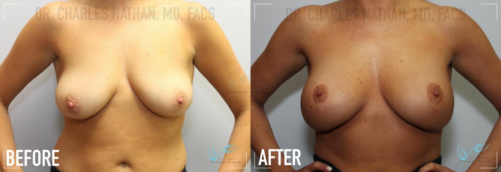 Before & After Breast Augmentation Case 150 Front View in St. Louis, MO