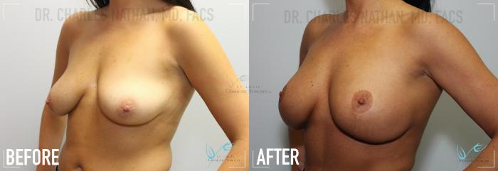 Before & After Breast Augmentation Case 150 Left Oblique View in St. Louis, MO