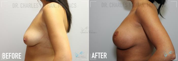 Before & After Breast Lift Case 150 Left Side View in St. Louis, MO
