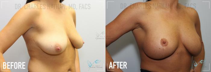 Before & After Breast Lift Case 150 Right Oblique View in St. Louis, MO