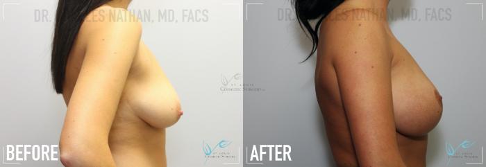 Before & After Breast Augmentation Case 150 Right Side View in St. Louis, MO
