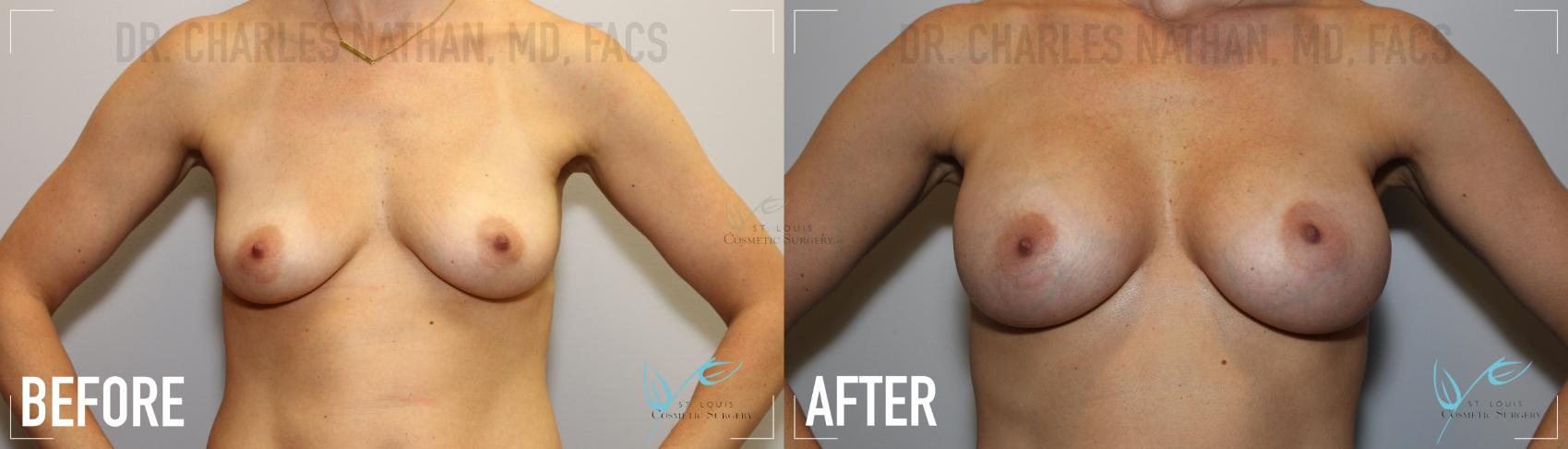 Before & After Breast Augmentation Case 153 Front View in St. Louis, MO