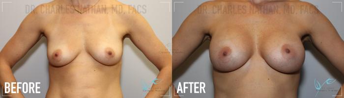 Before & After Breast Augmentation Case 153 Front View in St. Louis, MO