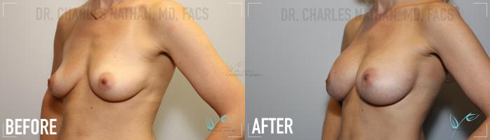 Before & After Breast Augmentation Case 153 Left Oblique View in St. Louis, MO