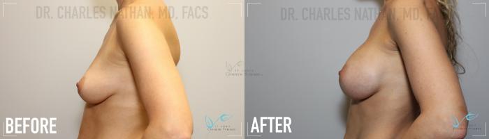 Before & After Breast Augmentation Case 153 Left Side View in St. Louis, MO