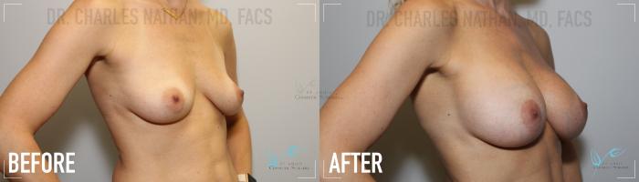 Before & After Breast Augmentation Case 153 Right Oblique View in St. Louis, MO