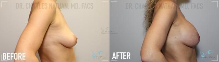 Before & After Breast Augmentation Case 153 Right Side View in St. Louis, MO