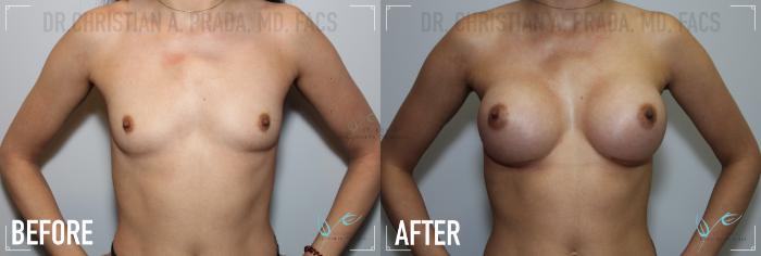 Before & After Breast Augmentation Case 154 Front View in St. Louis, MO
