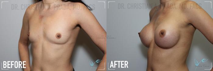 Before & After Breast Augmentation Case 154 Left Oblique View in St. Louis, MO