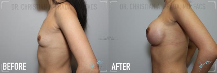 Before & After Breast Augmentation Case 154 Left Side View in St. Louis, MO