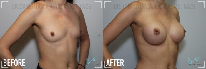 Before & After Breast Augmentation Case 154 Right Oblique View in St. Louis, MO