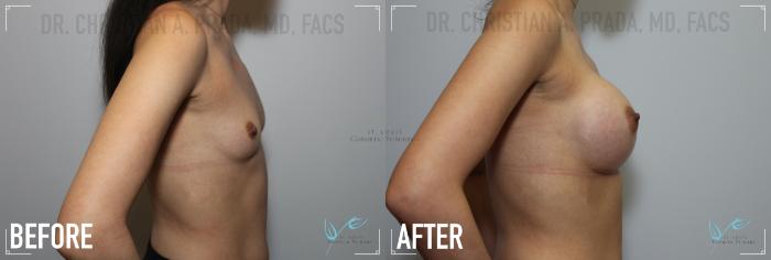 Before & After Breast Augmentation Case 154 Right Side View in St. Louis, MO