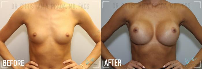 Before & After Breast Augmentation Case 159 Front View in St. Louis, MO