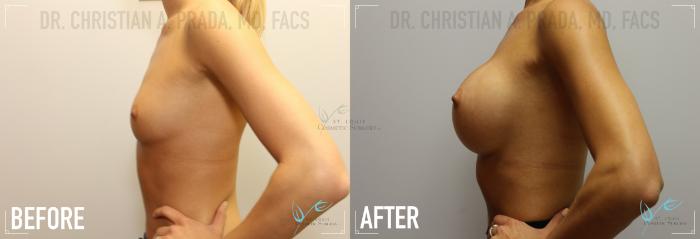 Before & After Breast Augmentation Case 159 Left Side View in St. Louis, MO