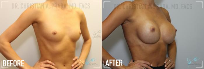 Before & After Breast Augmentation Case 159 Right Oblique View in St. Louis, MO
