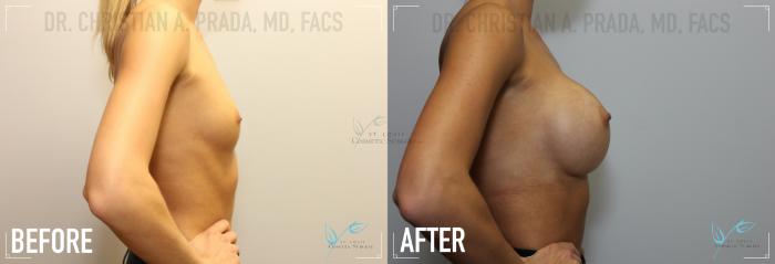 Before & After Breast Augmentation Case 159 Right Side View in St. Louis, MO