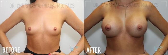 Before & After Breast Augmentation Case 162 Front View in St. Louis, MO