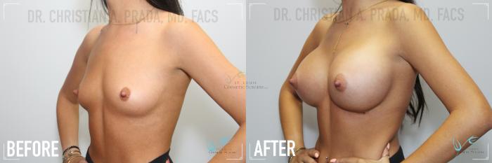 Before & After Breast Augmentation Case 162 Left Oblique View in St. Louis, MO