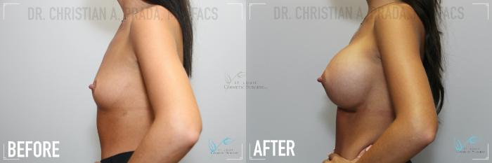 Before & After Breast Augmentation Case 162 Left Side View in St. Louis, MO