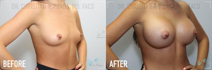 Before & After Breast Augmentation Case 162 Right Oblique View in St. Louis, MO