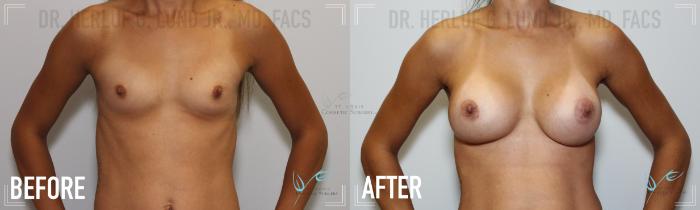 Before & After Breast Augmentation Case 165 Front View in St. Louis, MO